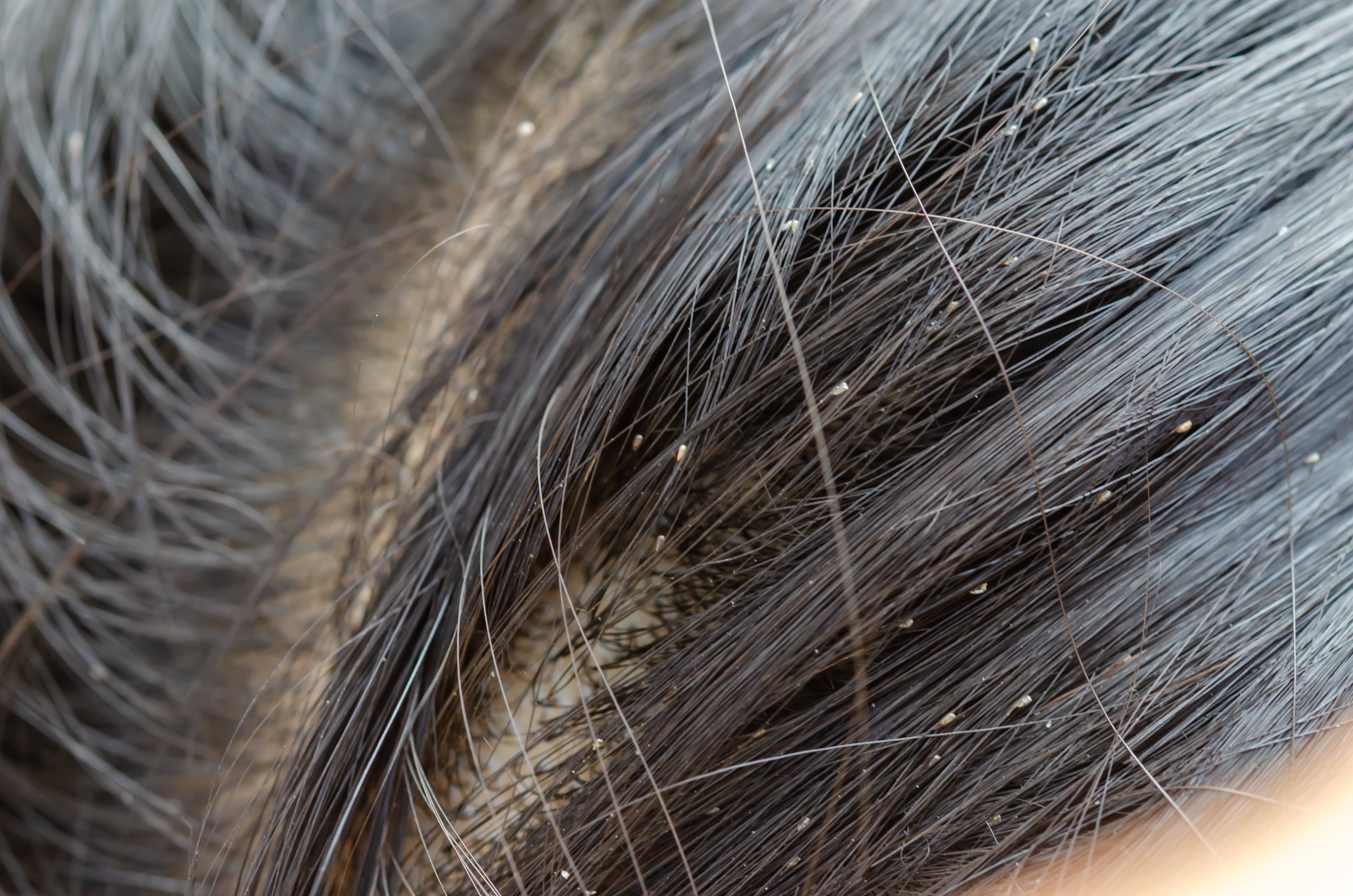 Dandruff