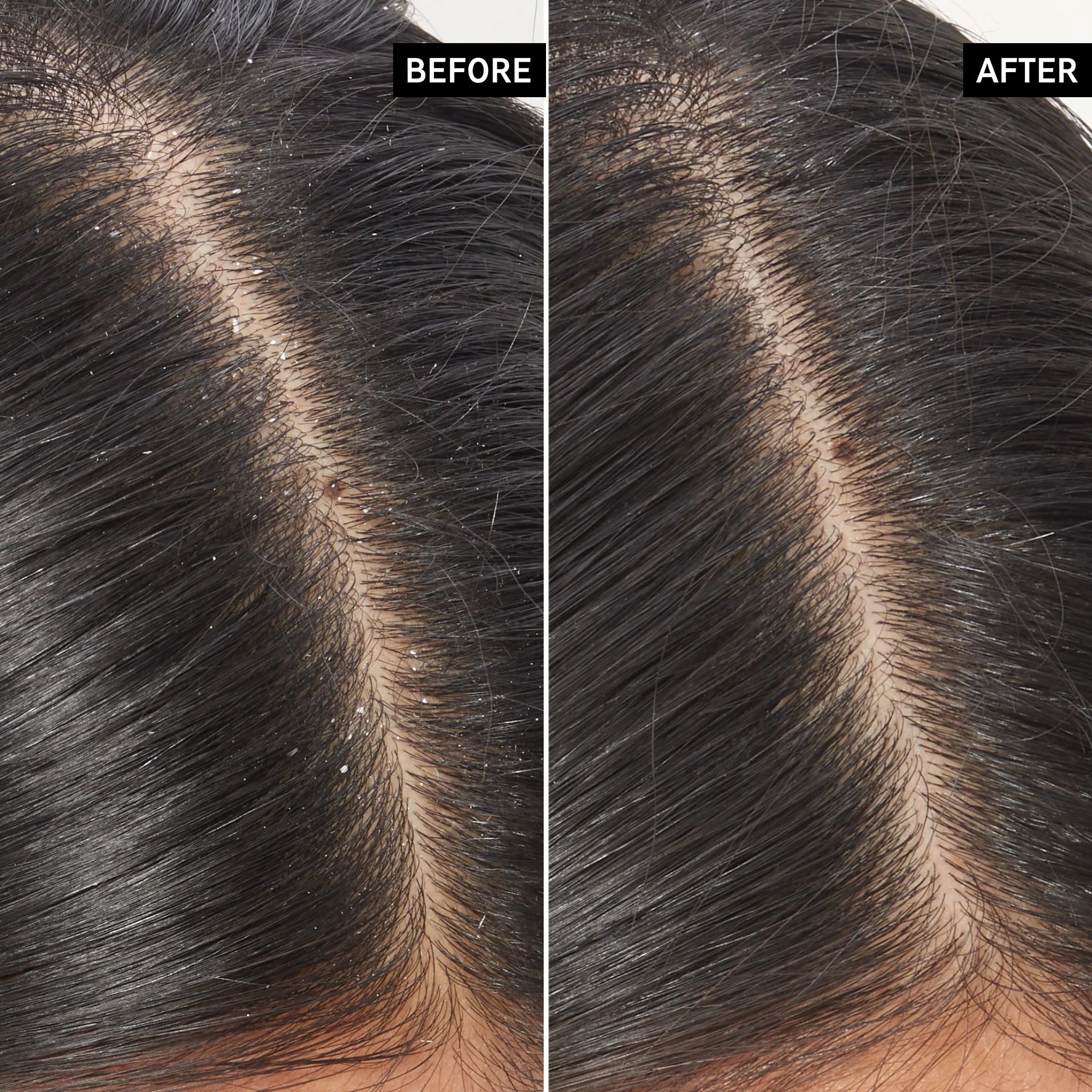 Inkey_List_Salicylic_Acid_Scalp_Treatment_Before_After