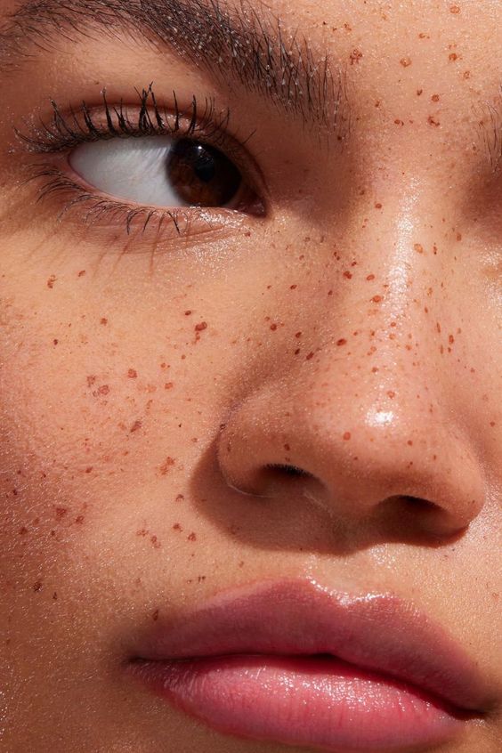 pigmentation_close_up_freckles_2.jpg