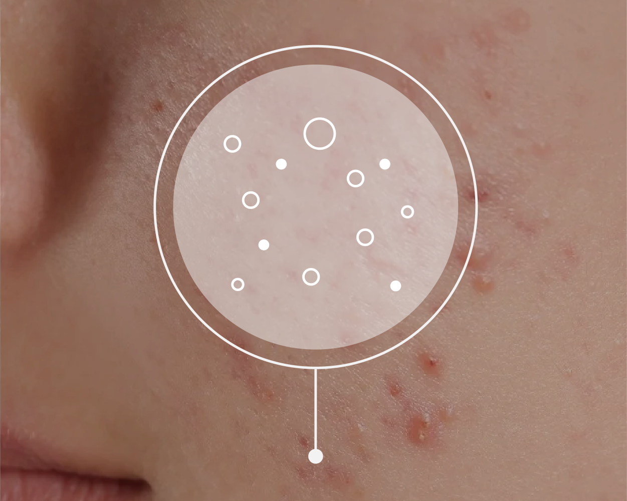 Dr. Laura GP adult acne guide Phare