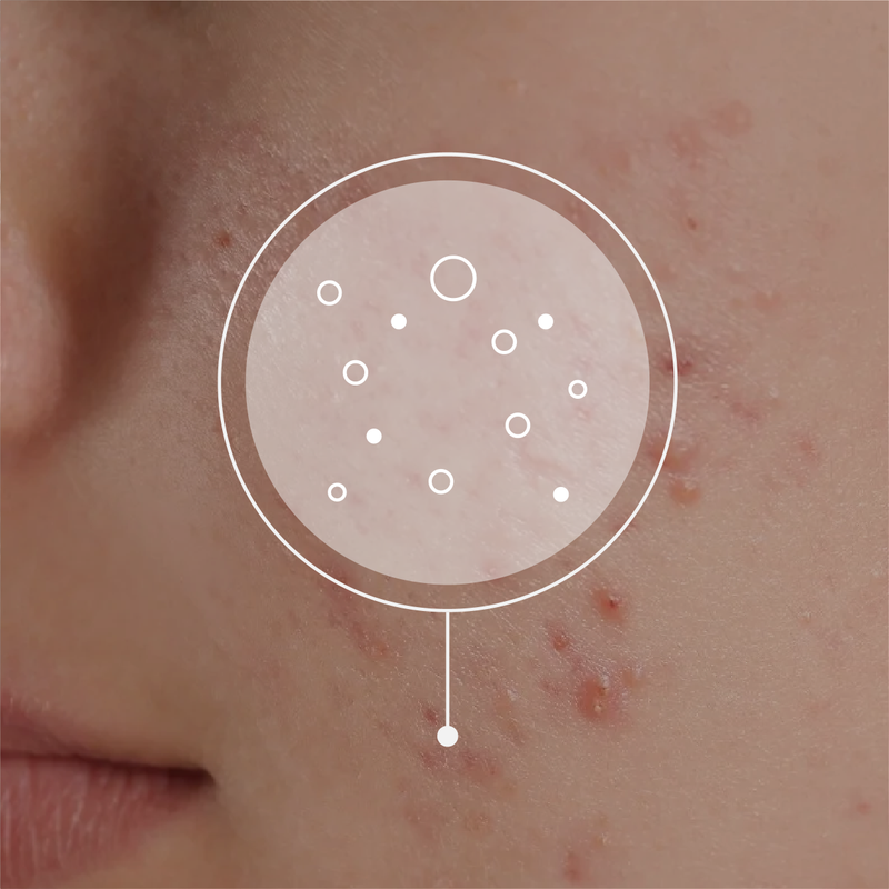 Dr. Laura GP adult acne guide Phare
