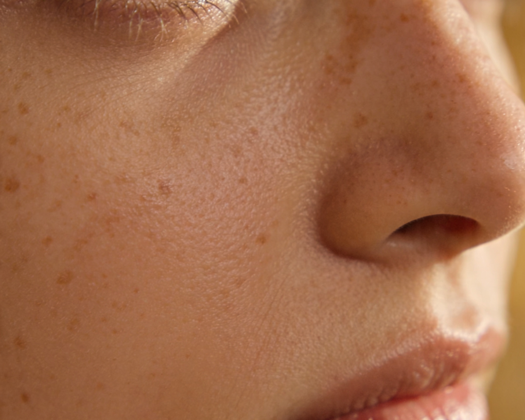 Dark Spots, Melasma and Sun Damage: What's the Difference and How to Treat Each One