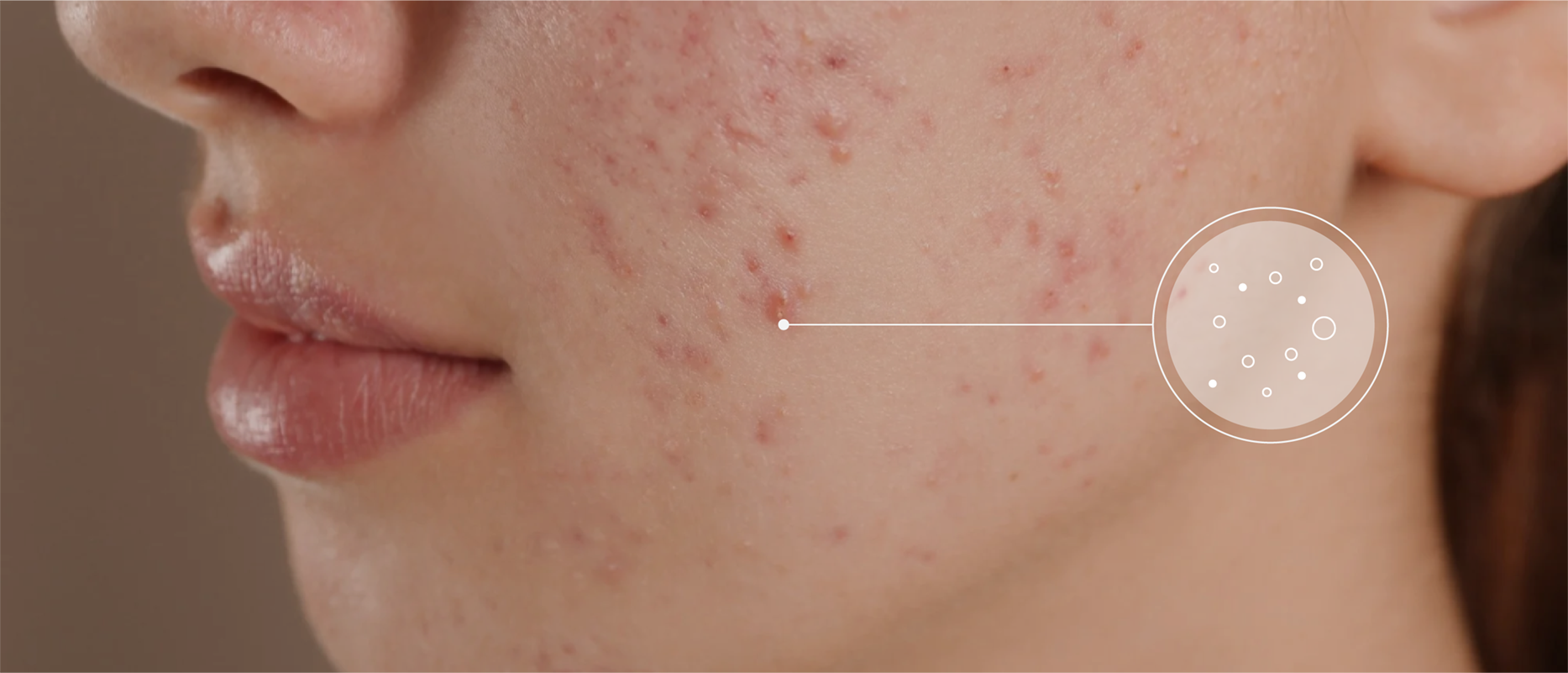 Close-up of a persons face showing acne on the cheek. A magnified circular information-icon highlights skin texture with small spots and blemishes. The background is neutral.