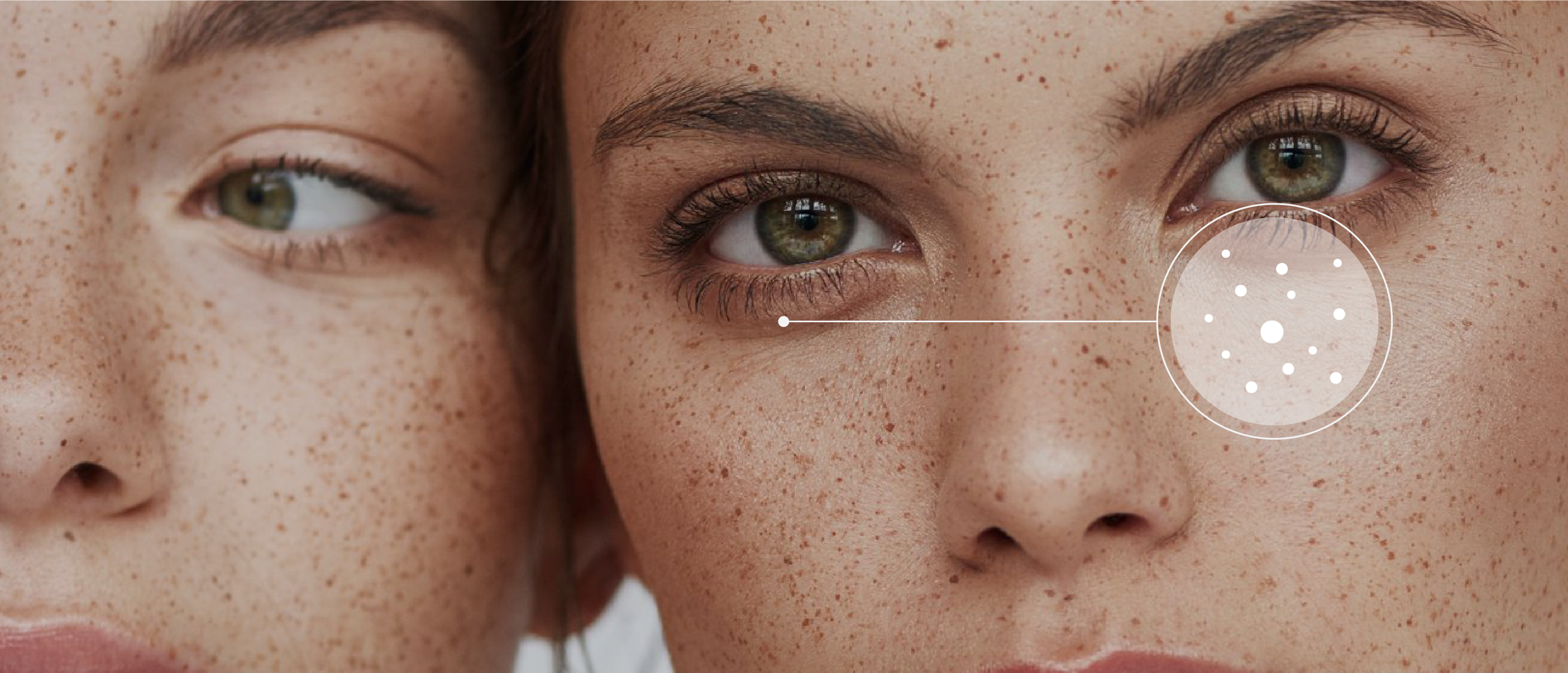 Close up of two female faces with freckles and circular info-icon indicating pigmentation on the skin.