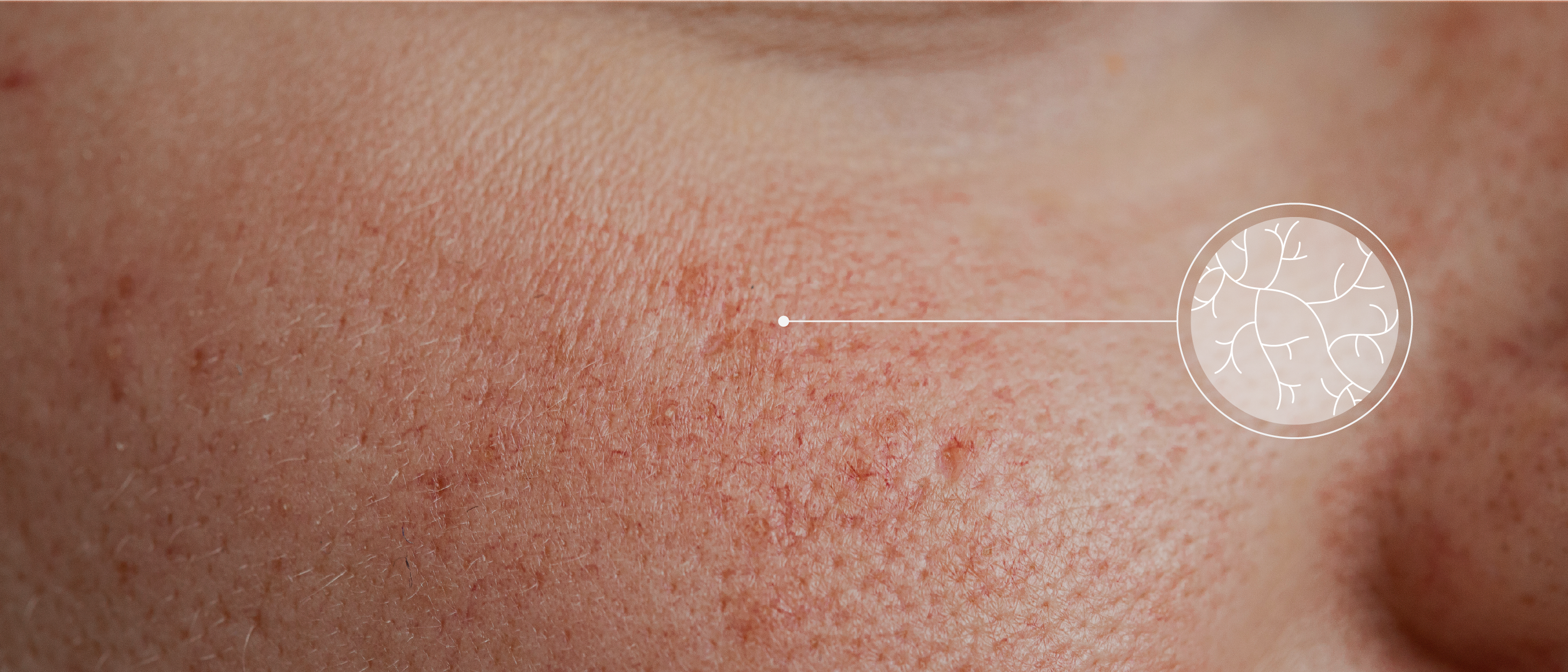 Extreme close-up of redness and rosacea on a face with a circular, white info-icon denoting blood vessels and line indicating the skin condition. 