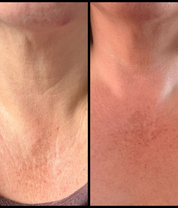 Bio-Active Ceramide Neck Stick