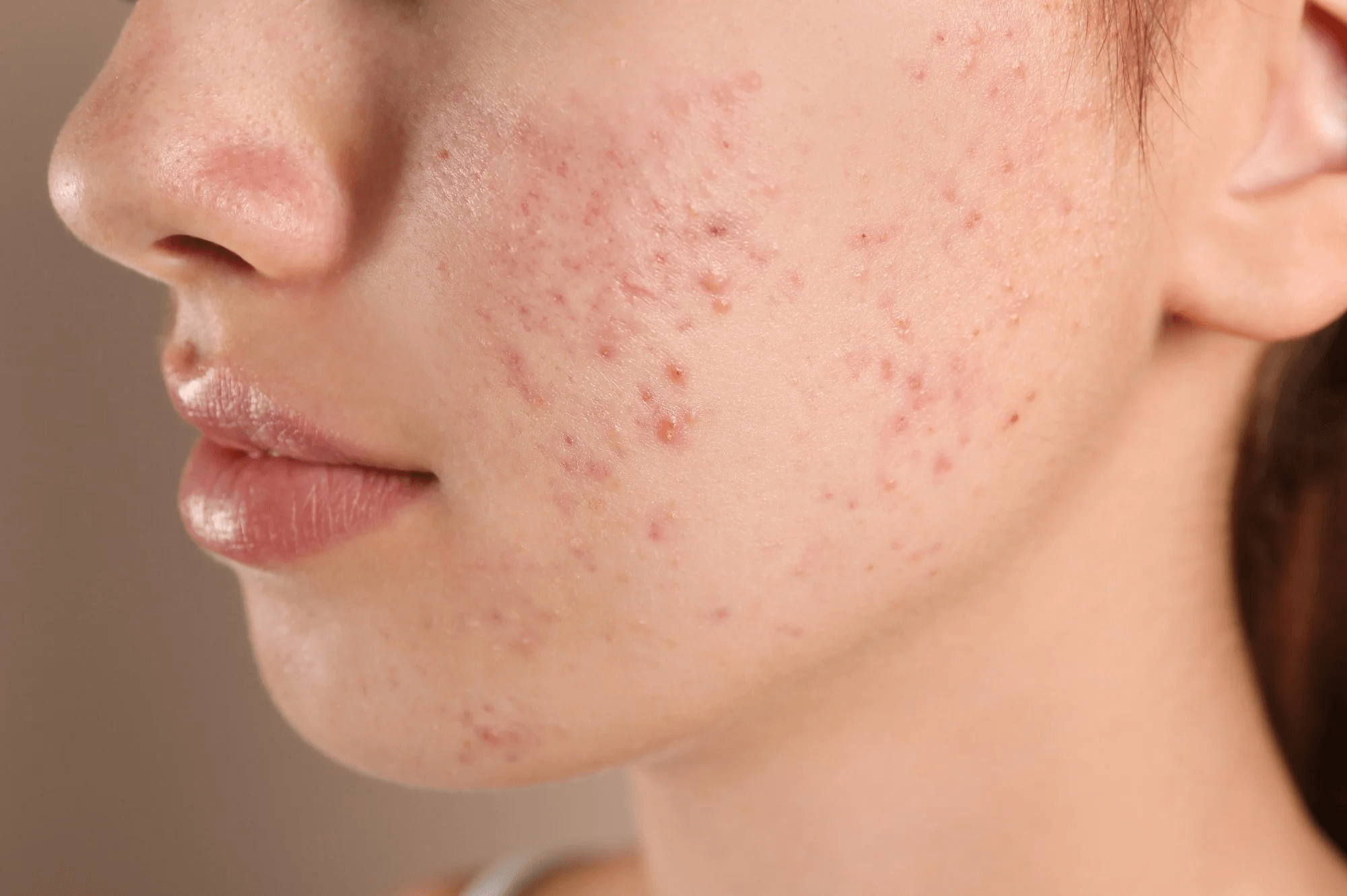 Close up of a face with acne on cheek and info-icon with circles and a line indicating the acne with a light grey transparent overlay.