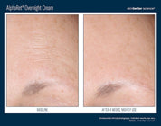 AlphaRet Overnight Cream Before and After forehead wrinkles