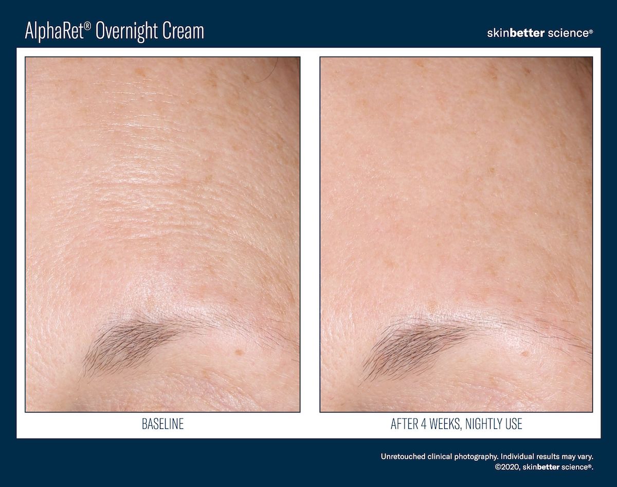 AlphaRet Overnight Cream Before and After forehead wrinkles