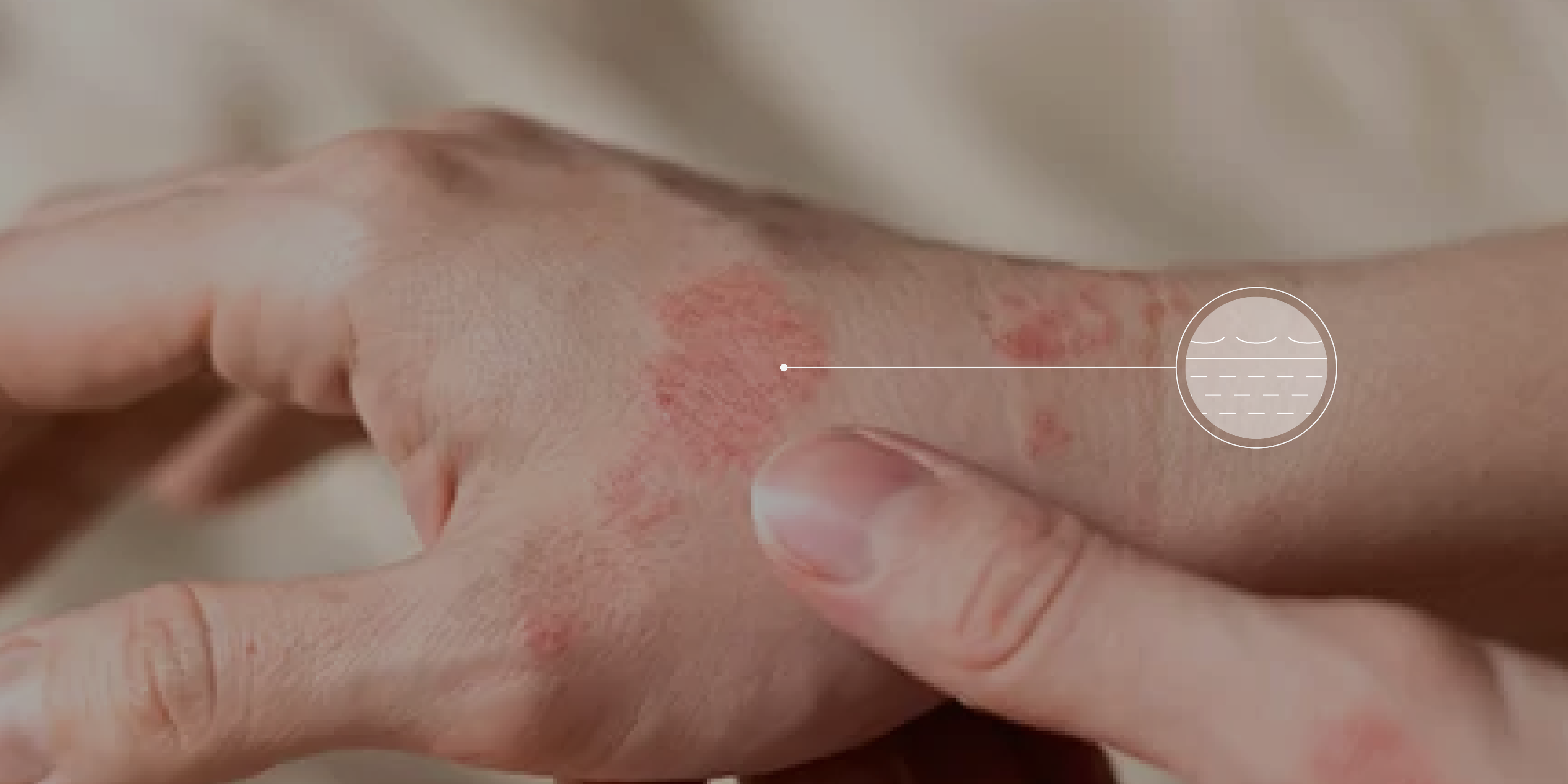 A close-up of a hand with red, irritated patches on the skin. A circular diagram overlays the image, illustrating the texture of the skin condition.