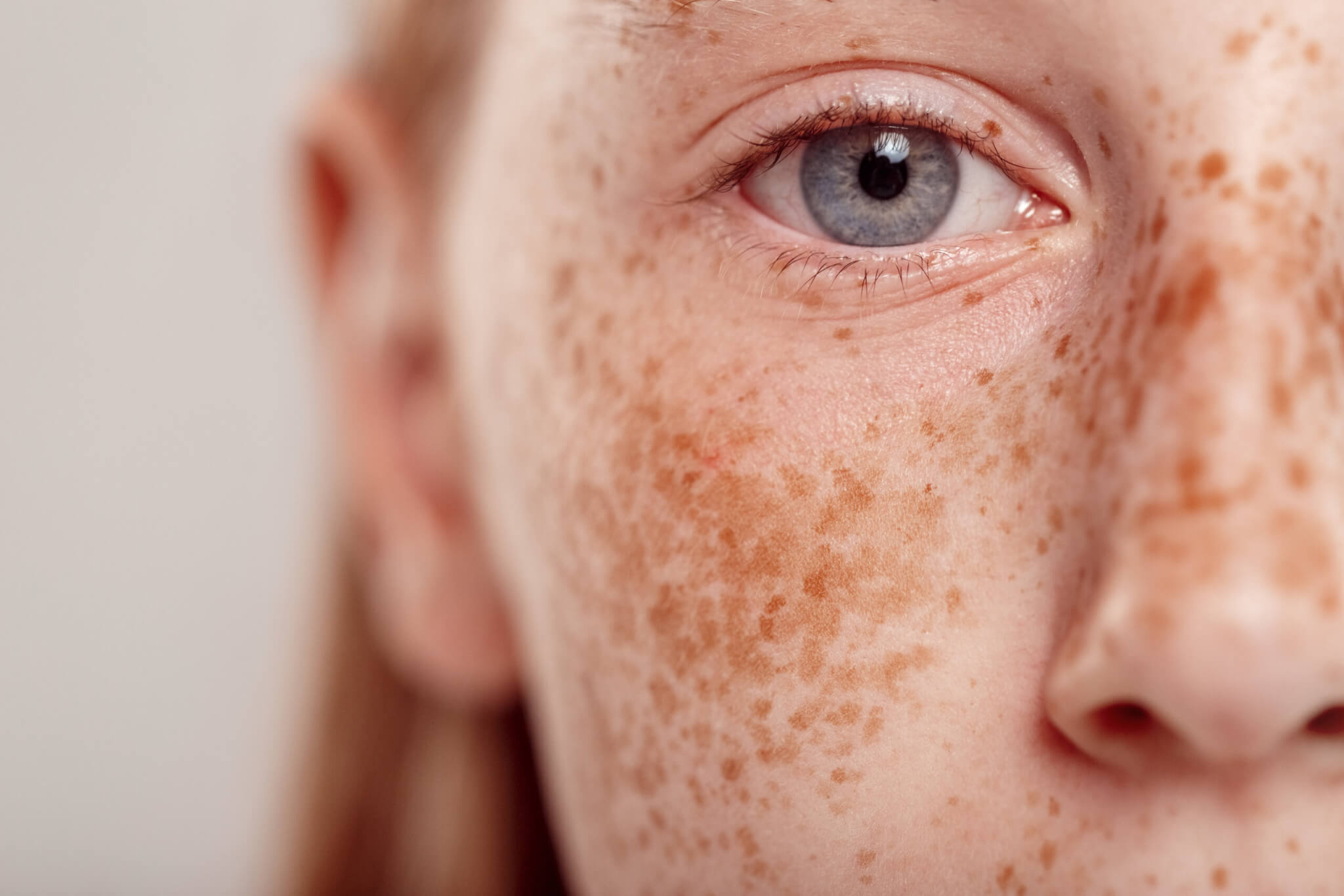 FRECKLES