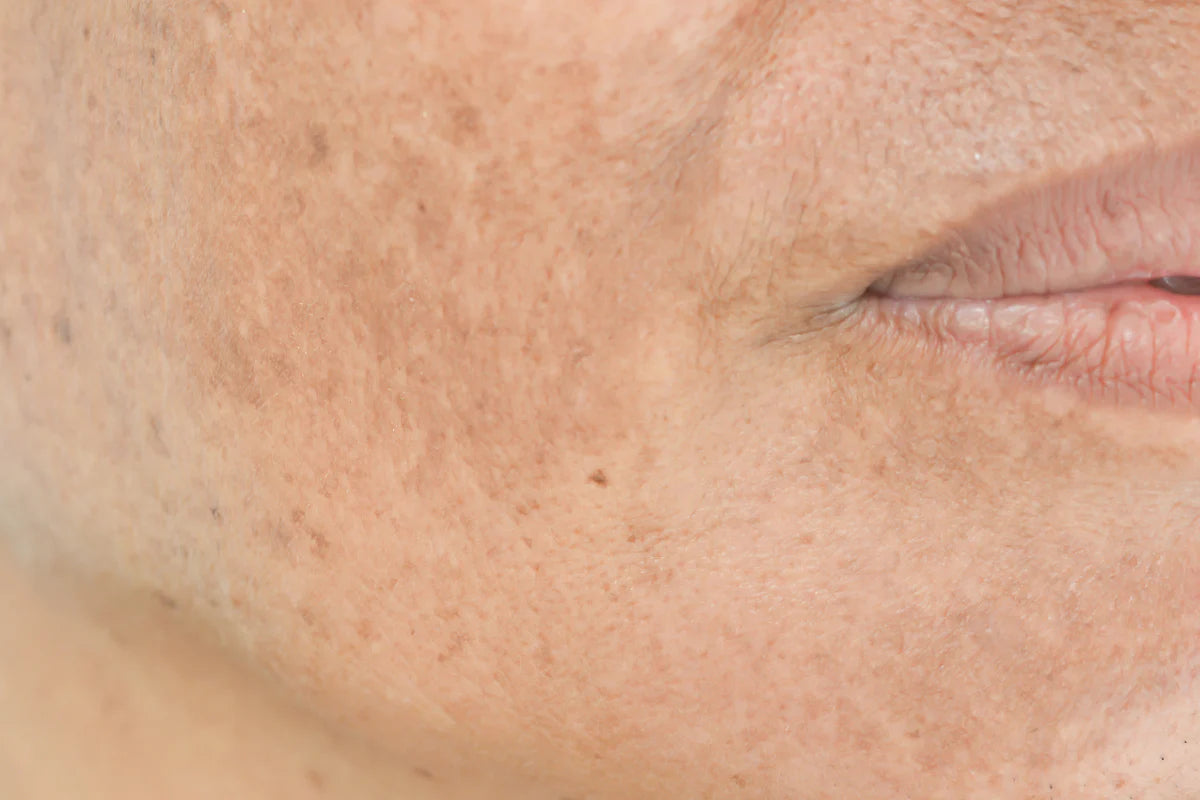 HORMONAL PIGMENTATION
