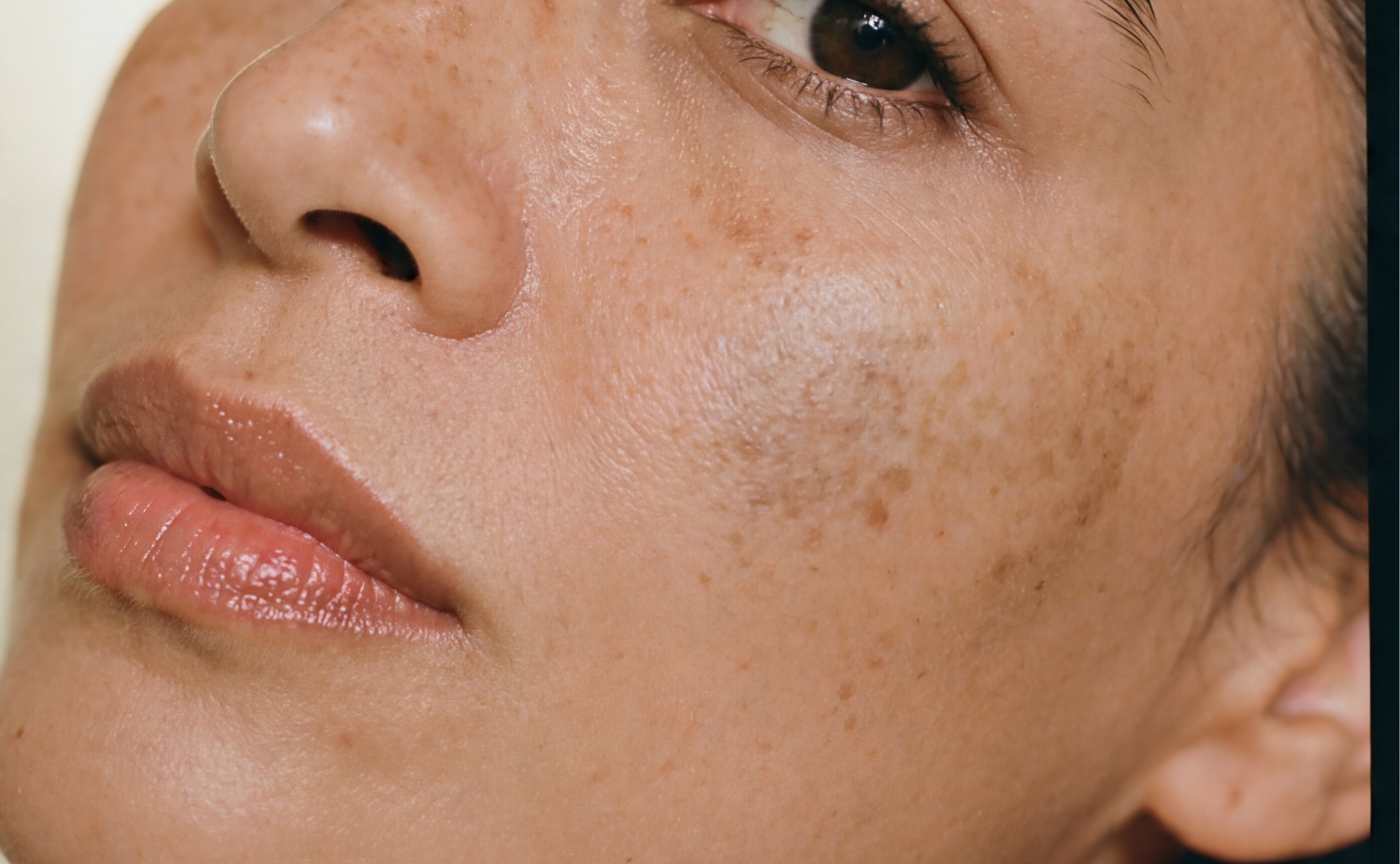 MELASMA