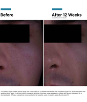SkinCeuticals P-TIOX Cream micro-melting gel-cream texture closeup before and after model