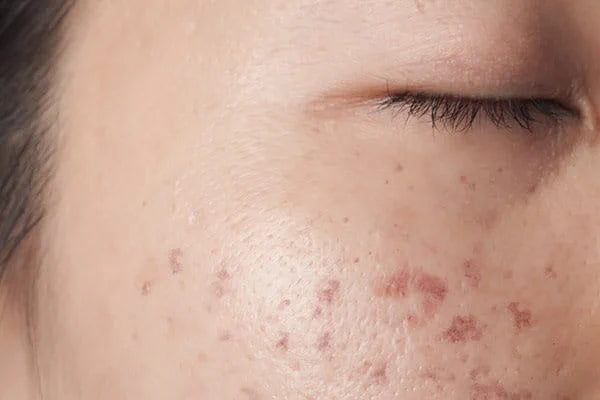 POST-INFLAMMATORY HYPERPIGMENTATION