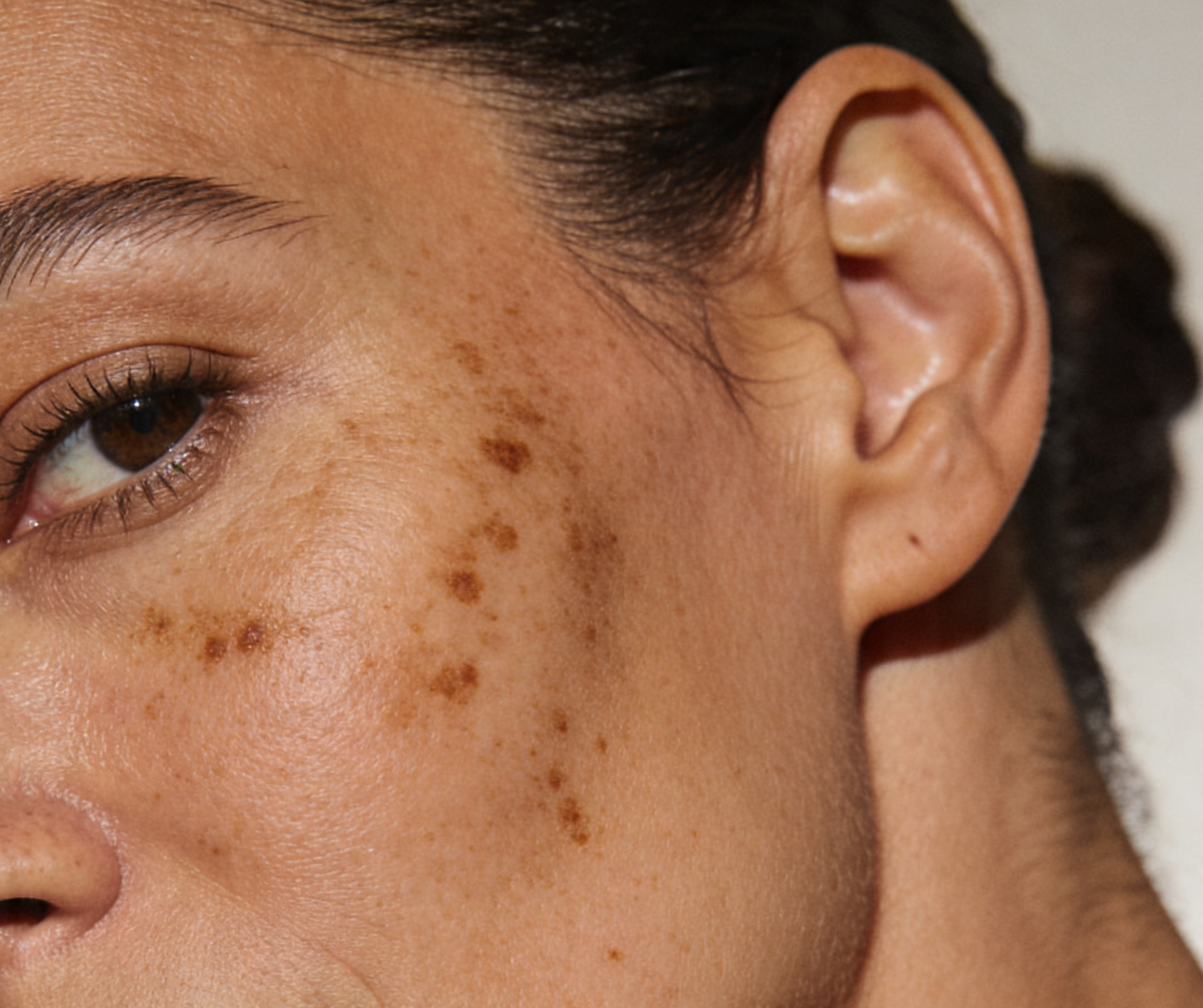 SUN DAMAGE