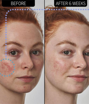 The Inkey List Redness Relief Serum  before and after 6 weeks